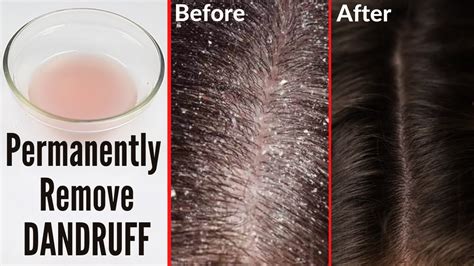How To Reduce Dandruff In Hair Naturally At Home