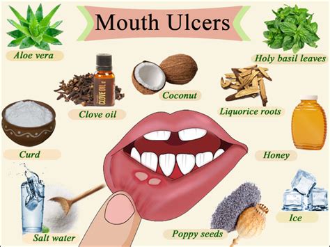 How to naturally get rid of Canker sores or Mouth Ulcer in minutes