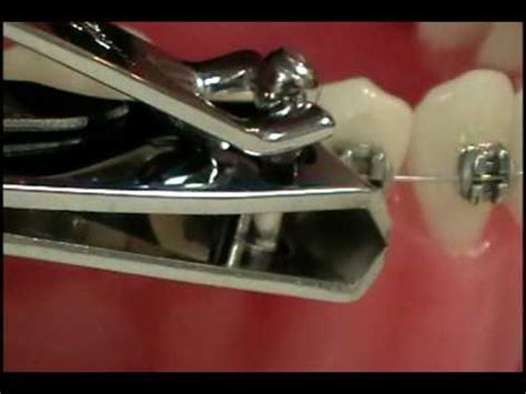 How To Cut Braces Wire Without Nail Clipper