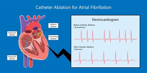 Atrial Fibrillation cdc.gov