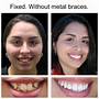 how to fix uneven teeth without braces