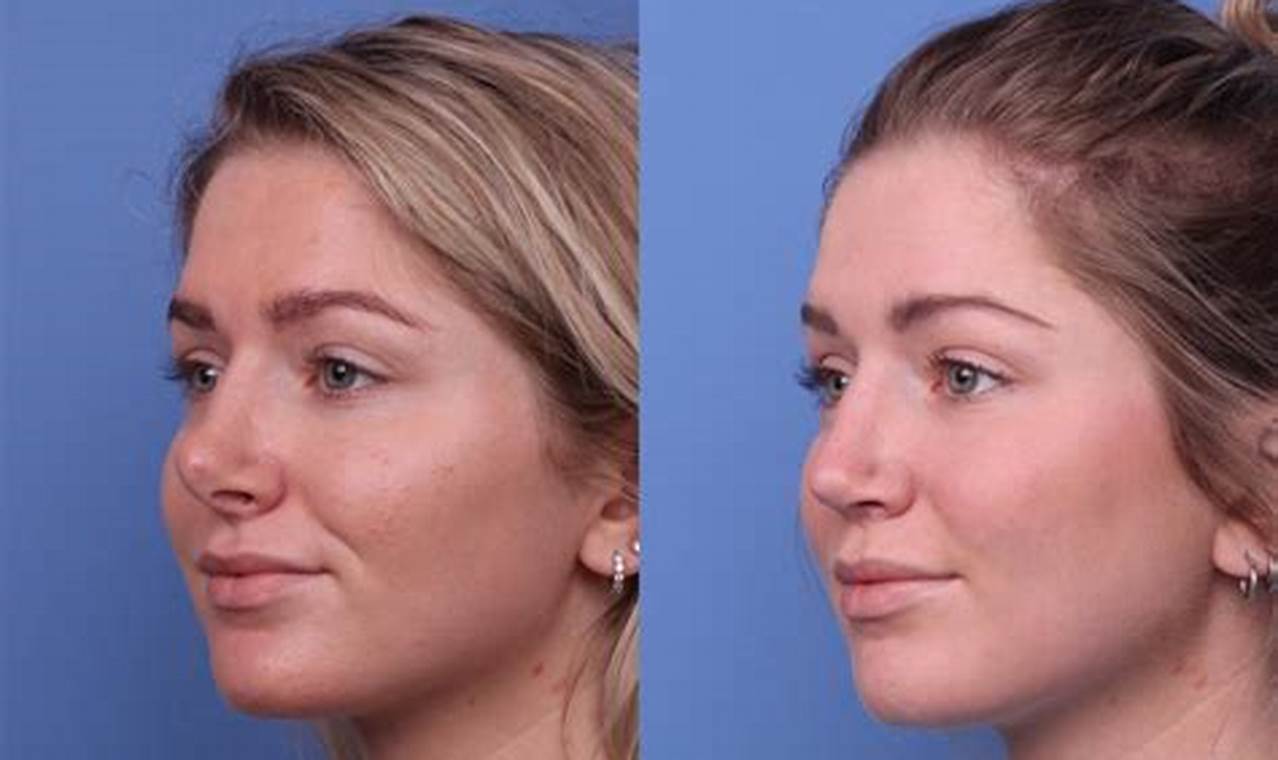 How To Get Insurance To Cover Nose Job