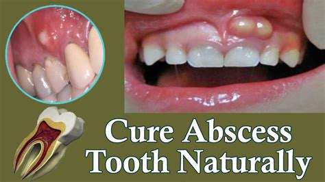 How To Get Rid Of A Tooth Abscess Fast