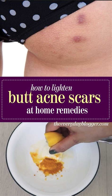 how to get rid of acne scars on buttocks