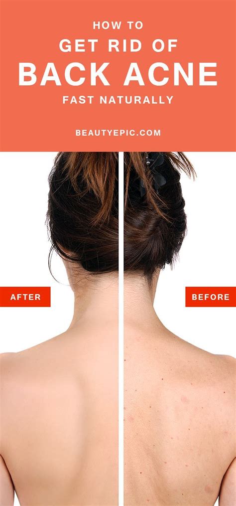 how to get rid of back acne fast
