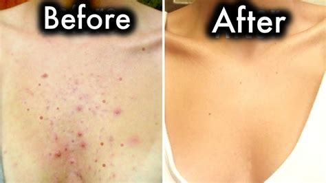 how to get rid of chest acne female