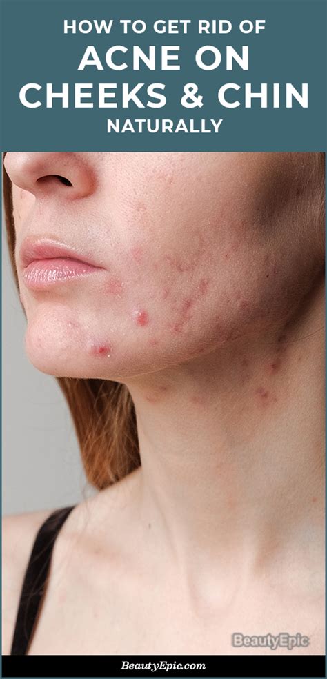 how to get rid of chin acne naturally