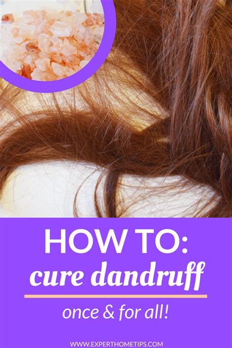 You are currently viewing How To Get Rid Of Dandruff: A Comprehensive Guide
