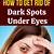 how to get rid of hereditary dark circles permanently