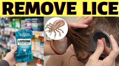 How To Get Rid Of Lice Without Cutting Hair