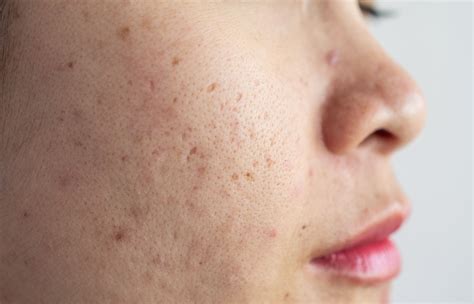how to get rid of pitted acne scars