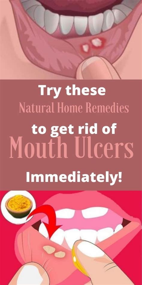 How to cure canker sores and mouth sores? Family