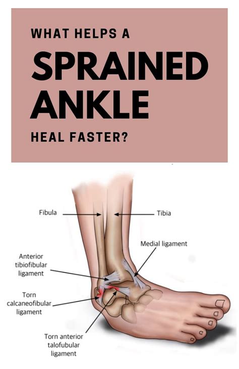 What Helps A Sprained Ankle Heal Faster Sprained ankle, Sprained