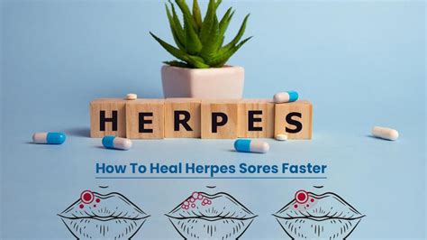Tips to manage herpes outbreak »