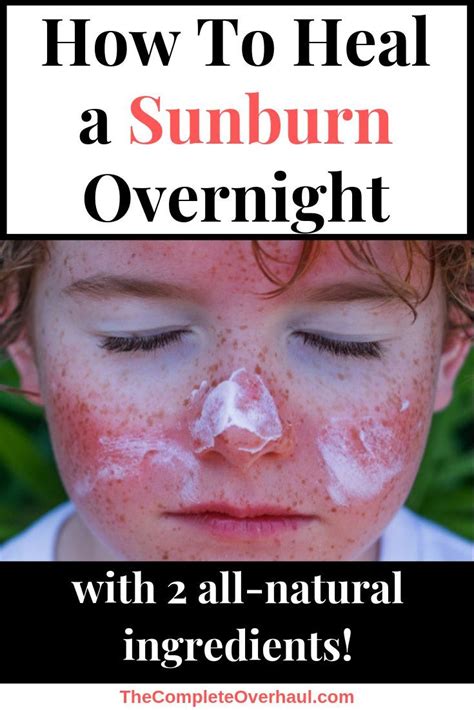 How long does sunburn last?