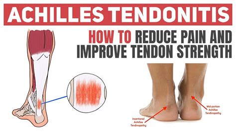 How Runners Heal Achilles Tendinitis Without a Doctor and Keep Running