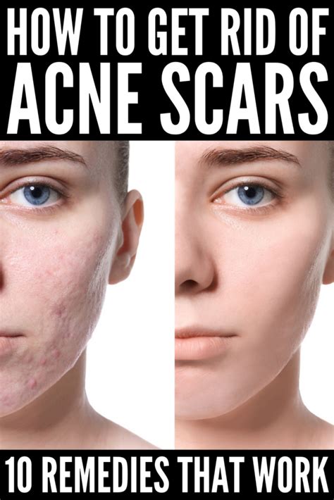 how to make acne scars go away