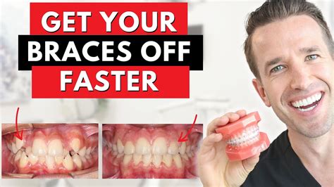 How to Get Your Braces off Faster 14 Steps (with Pictures)