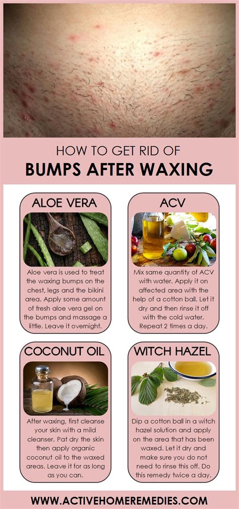 How to Get Rid of Bumps after Waxing Active Home Remedies