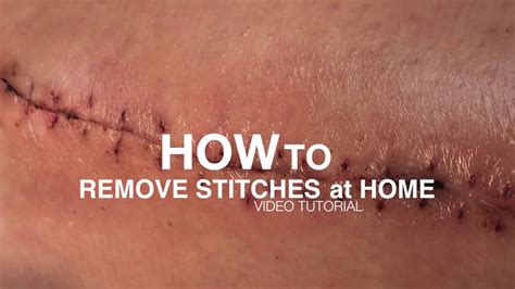how to remove a stitch at home