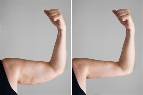 how to remove cellulite from arms