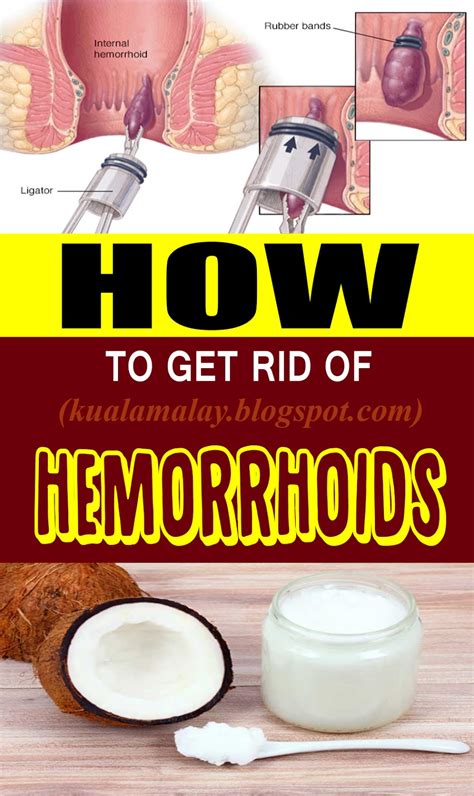 How to Get Rid of Hemorrhoids Without Surgery Home remedies for