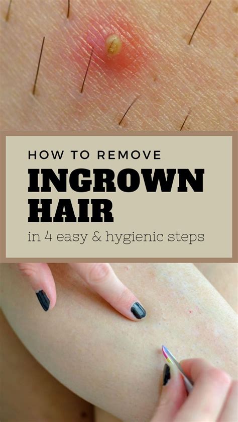 How To Remove Ingrown Hair At Home