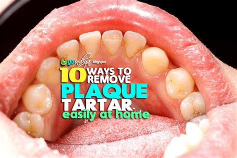 10 Easy Ways to Remove Plaque and Tartar from Teeth At Home Naturally