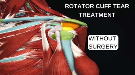 How To Treat A Partially Torn Rotator Cuff