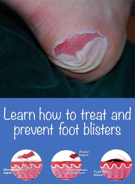 How To Treat Blisters On Feet