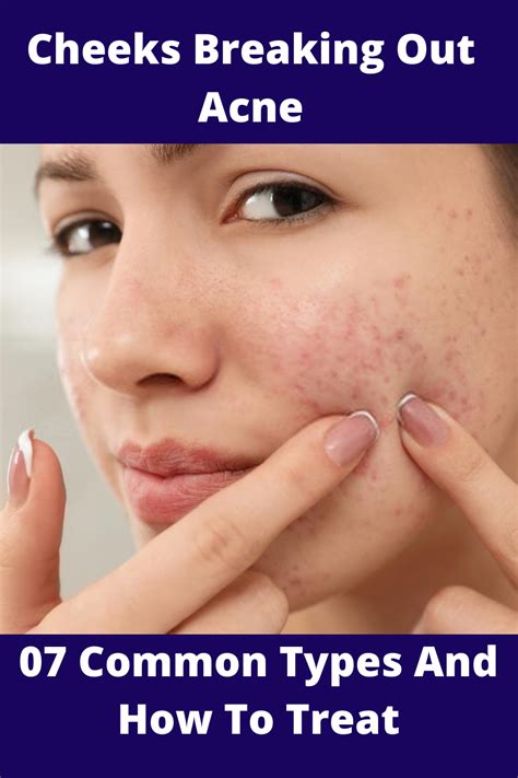how to treat cheek acne