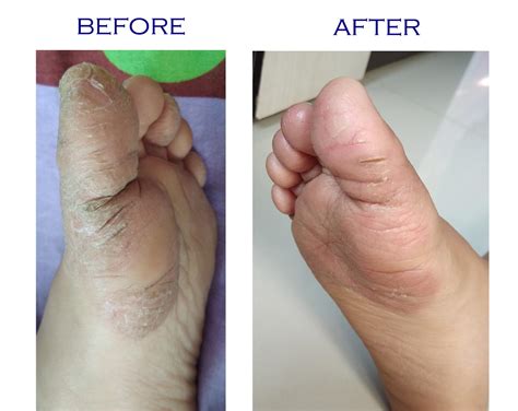 How To Treat Dry Cracked Skin Between Toes