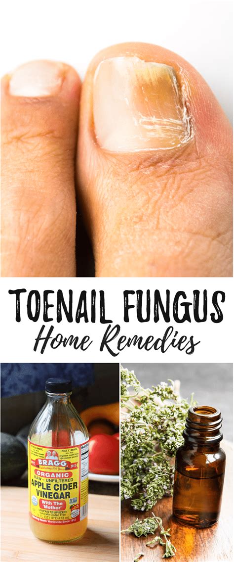 How To Treat Fungus Toenail At Home