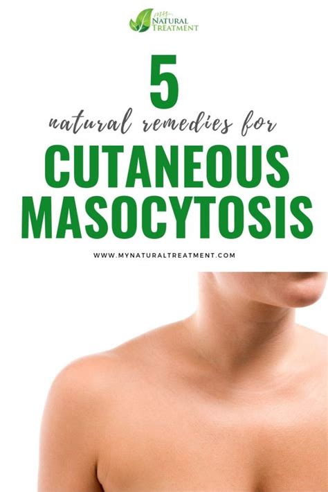 How To Treat Mastocytosis: A Guide For Patients