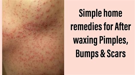 Home Treatment for Bumps After Waxing