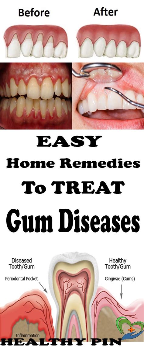 How To Treat Severe Gum Disease At Home
