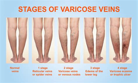 How To Treat Vulvar Varicosities