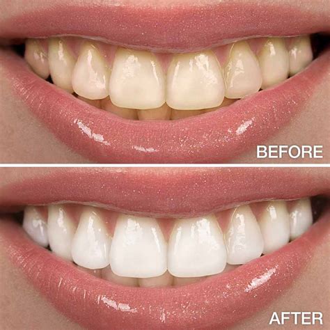 Are AtHome Teeth Whitening Kits Safe/Good? Mona Vale Dental