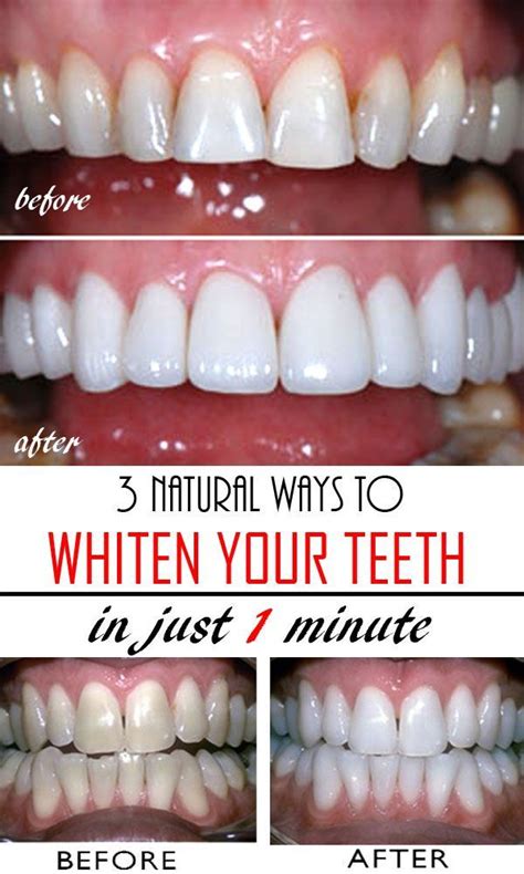 How to whiten your teeth naturally