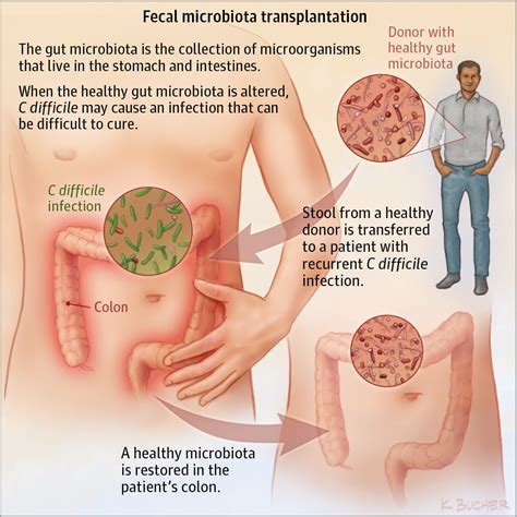 How Accurate Are Stool Tests For C-Diff