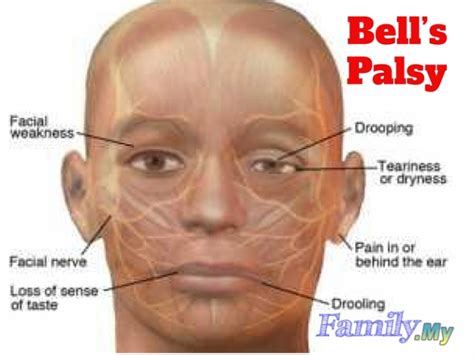 how bell's palsy affects the nervous system