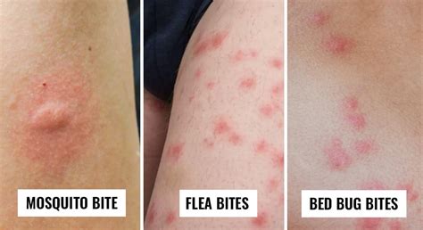 How Bug Are Bed Bug Bites
