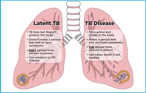 Understanding Tuberculosis: How Can I Get Tested for TB