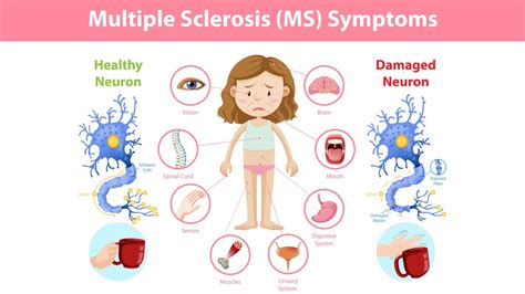 How Can I Prevent Multiple Sclerosis