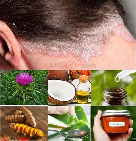 How Can I Stop Hair Loss From Psoriasis 