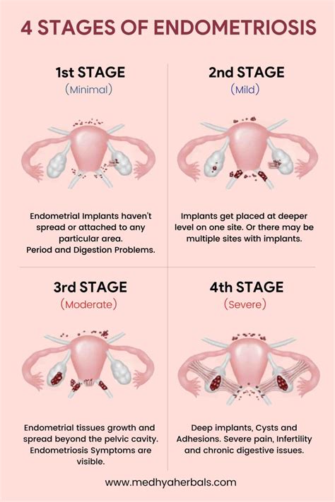 how can you diagnose endometriosis