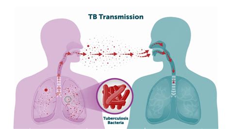 Understanding Tuberculosis: How Can You Get TB and What Are the Risks?
