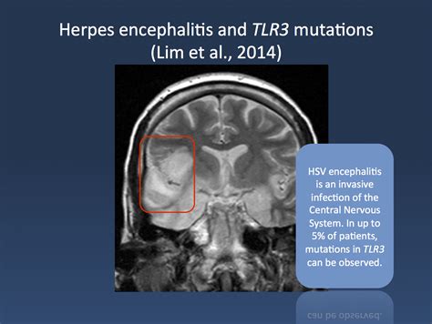 how common is hsv encephalitis