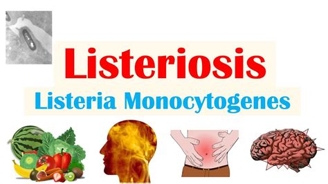 how common is listeria