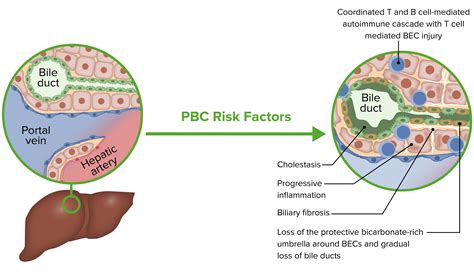 how common is primary biliary cholangitis